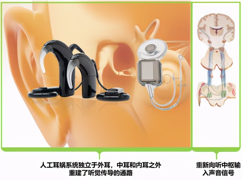 人工耳蜗vs助听器里应外合让声音更立体