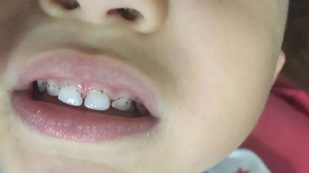 警惕孩子的牙齿上有黑点做家长的就要注意了
