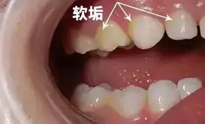警惕孩子的牙齿上有黑点做家长的就要注意了