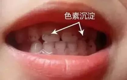 黑色素沉着:仅在牙齿表面形成污垢,保护层还没有被破坏.
