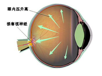 青光眼早期症状是什么?该如何预防治疗?上海和平眼科告诉你