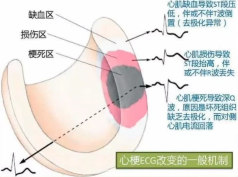 搭脉怎么判断早搏_早搏心电图怎么看图解(3)