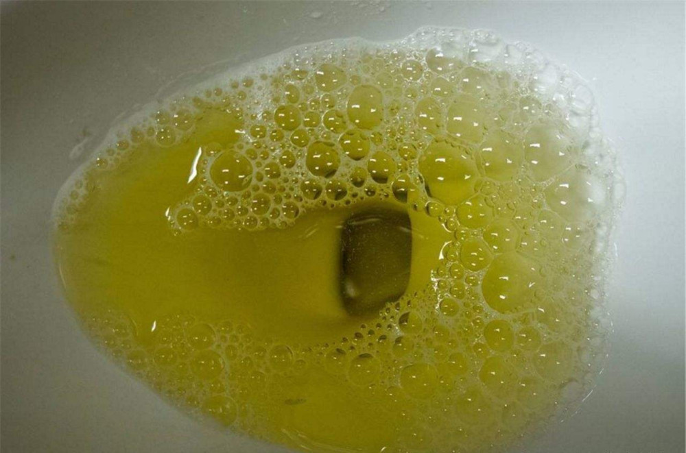 6,尿液清澈,少泡沫 正常人的小便是清澈透明的,且不会出现大量的长久