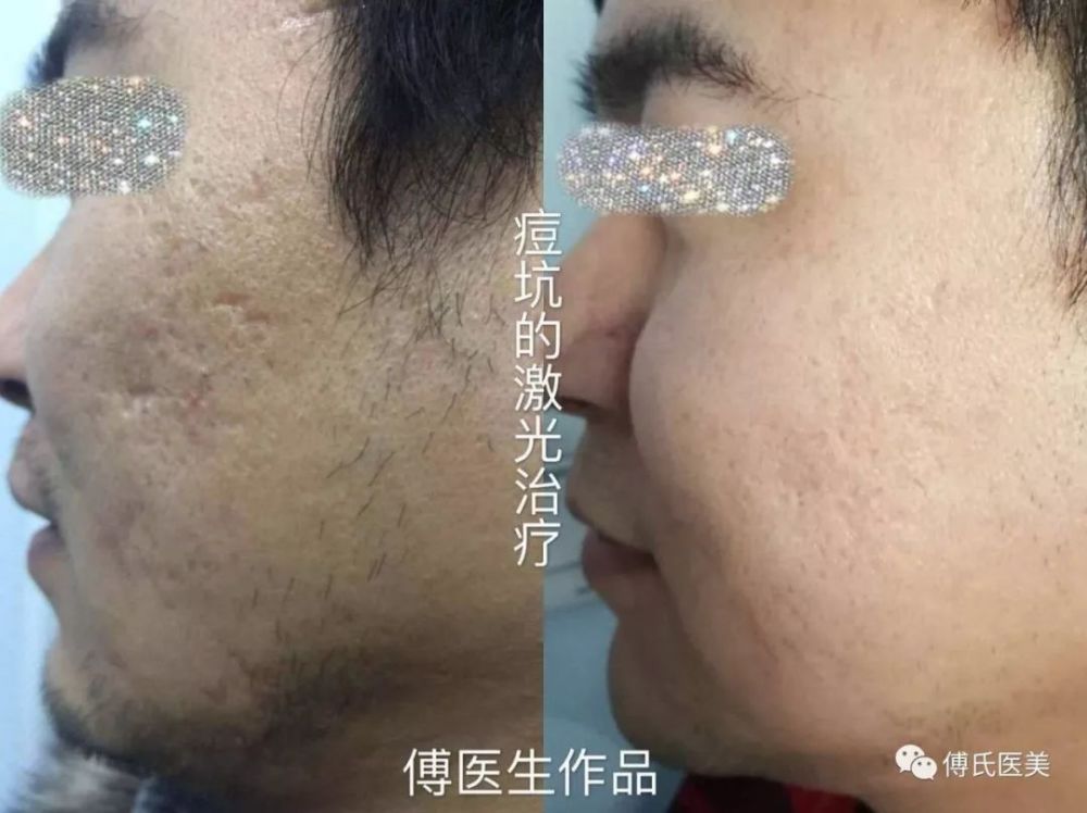郑州市九院二氧化碳点阵激光改善疤痕获好评