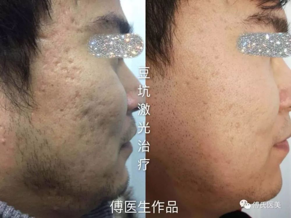 郑州市九院二氧化碳点阵激光改善疤痕获好评
