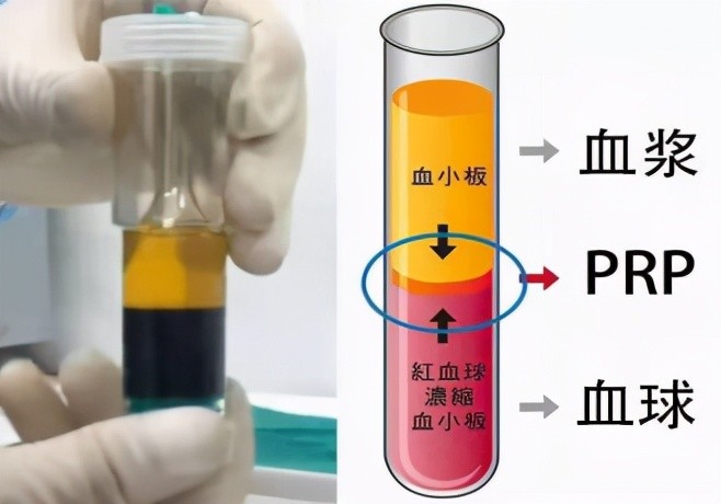 十,富含血小板血浆(prp)注射用于治疗膝关节骨性关节炎,顽固性网球肘