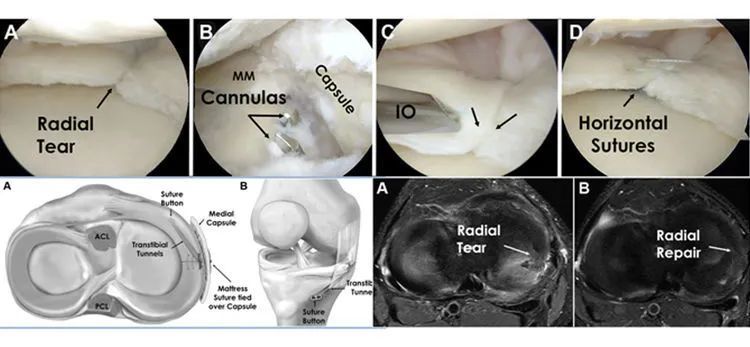 骨科精读一文带你读懂半月板缝合技术