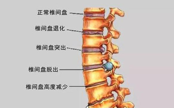 腰椎间盘突出合并马尾综合征有哪些症状什么是腰椎间盘突出压迫神经呢