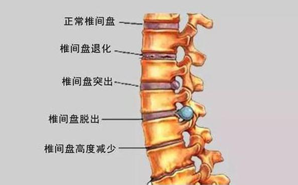 腰椎间盘突出合并马尾综合征有哪些症状?什么是腰椎间