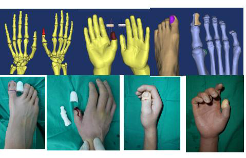 顺德和平外科医院科普:什么是3d全型手指再造 手指再造费用