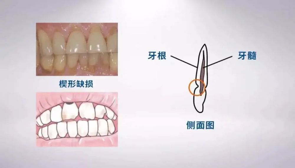 牙齿敏感,酸痛,可能是被刷出楔状缺损!_腾讯新闻