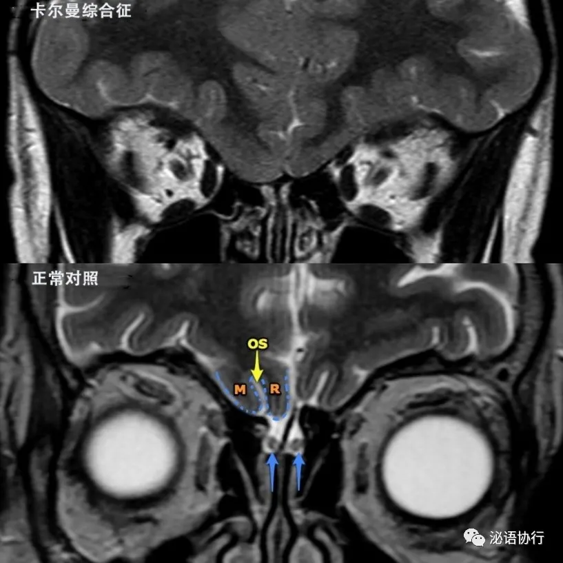 春天到了我却闻不到花香性幼稚伴有失嗅的卡尔曼综合征