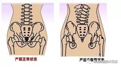 骨盆关节错位的类型