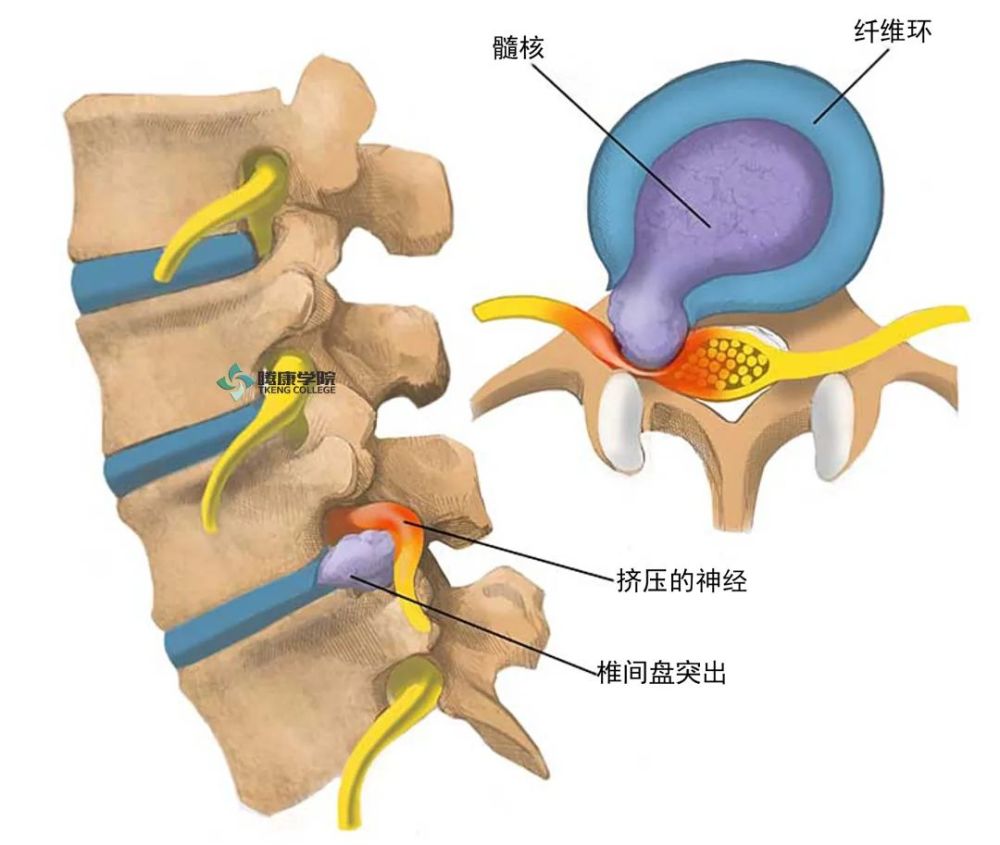 这种情况多见于腰4-5椎间盘突出,主要变现为足下垂,肌力减弱.