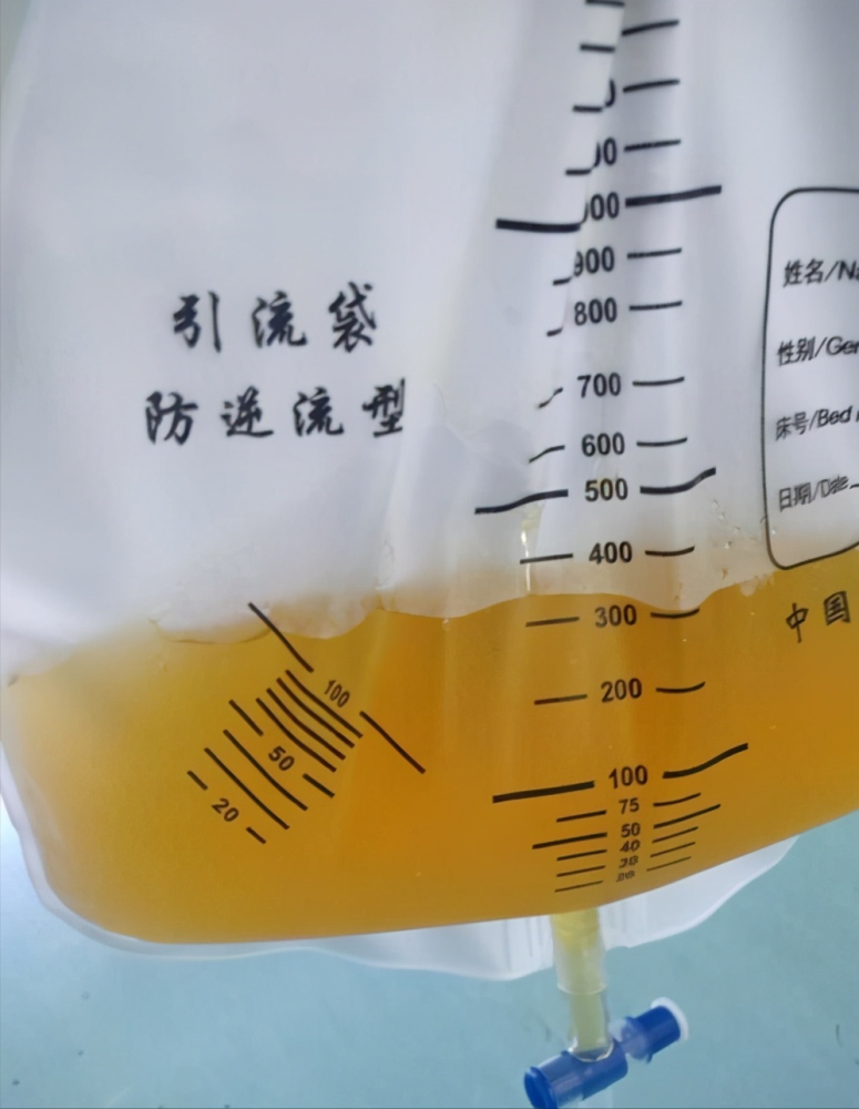 癌症病人胸腹水不能抽会越抽越多还加速死亡真的吗医生辟谣