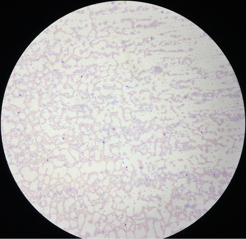 于是立即涂片镜检,镜检结果如下: 高倍镜40x 镜下血小板聚集明显,像