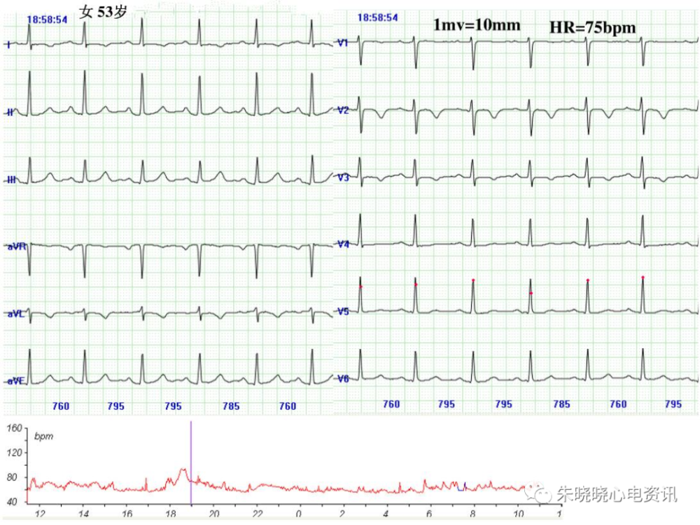 教你看懂心肌缺血发作时的心电图表现