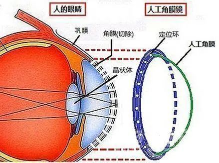 国产人工角膜上热搜!保护视力也愈发值得每一个人关注