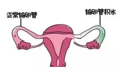 是哪些原因祸害了输卵管不通