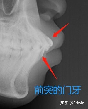 牙窝,相互交错,这样可以最大程度发挥咀嚼效率,另外在正常位置的牙齿