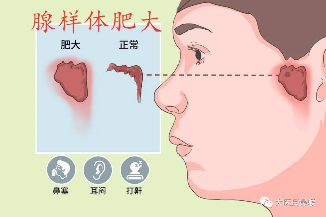 孩子腺样体肥大,会变丑吗?