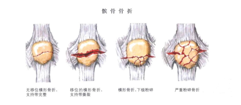 avulsion fracture图18:髌骨袖套状撕脱骨折是儿童特有的一种髌骨骨折