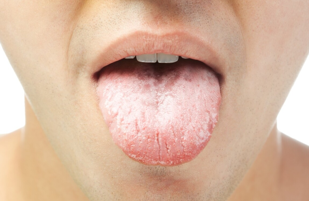 很多糖尿病患者的舌苔出现黏腻物质,像是长了一层绒毛一样的物质,这是