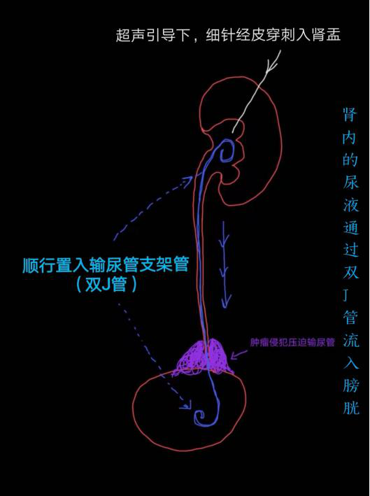 西安市中医医院多学科协作完成首例经皮肾输尿管支架管置入术