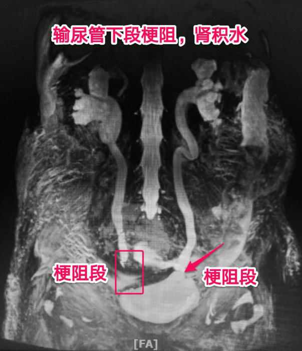 mri提示双输尿管下段梗阻,以上输尿管及肾盂重度扩张