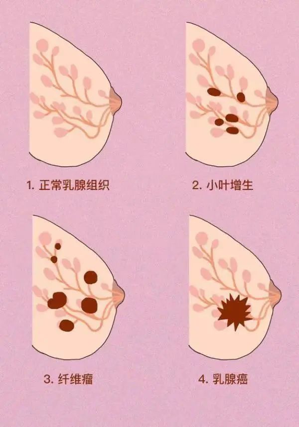 二,乳腺癌的五种症状