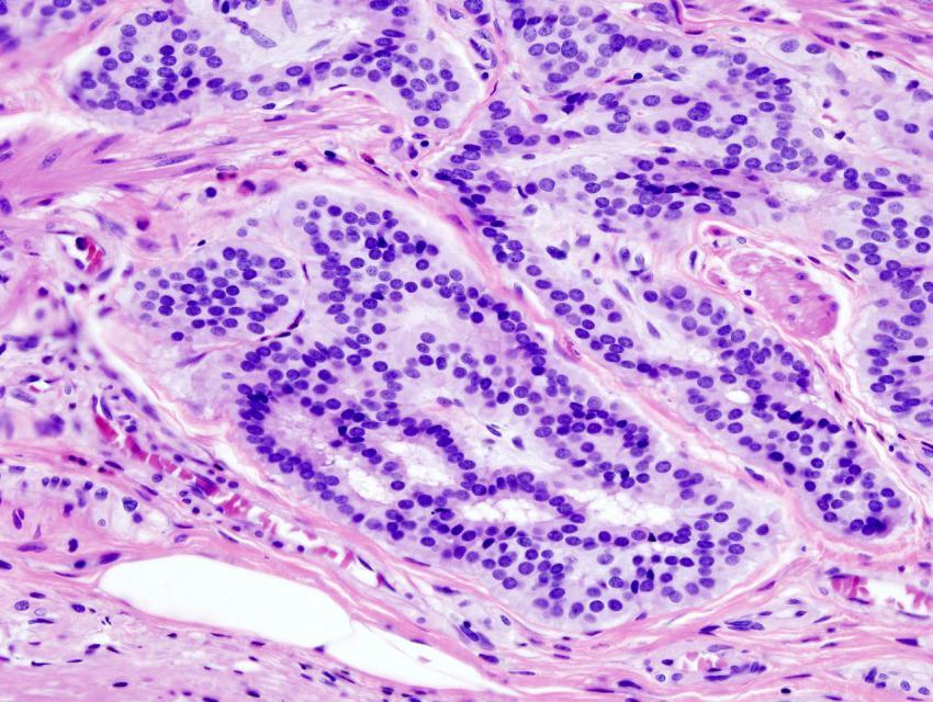 结肠癌:结肠类癌的组织病理学图像.资料来源:维基百科/cc by-sa 3.