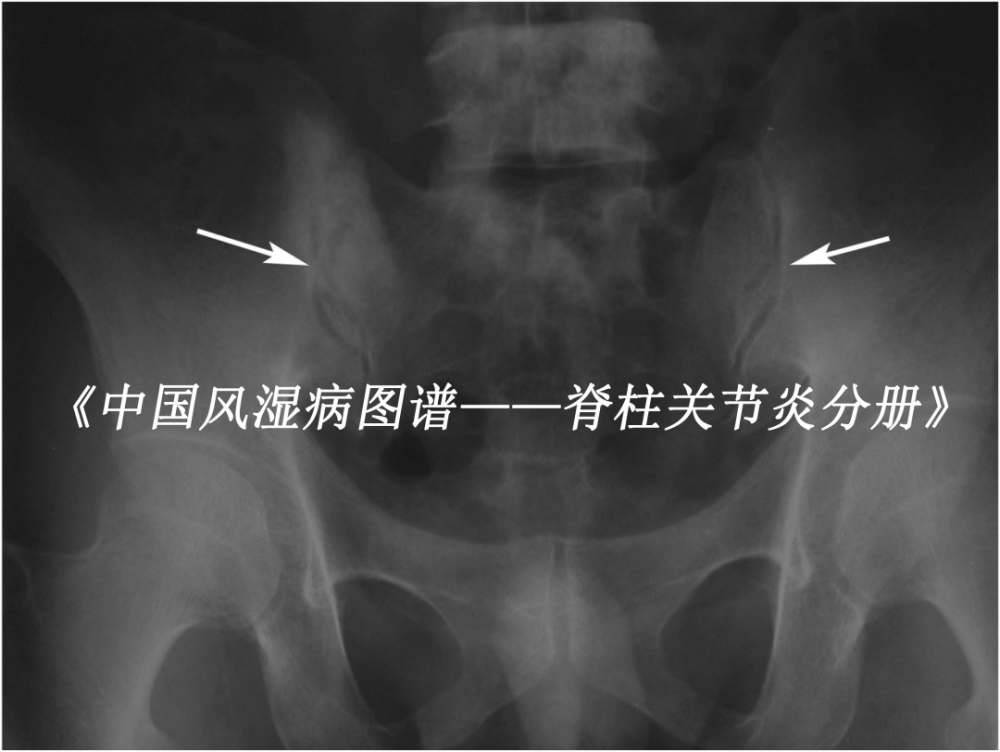 强直性脊柱炎患者,图为x线片示骶髂关节炎Ⅰ级(箭头处).