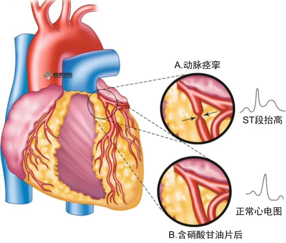 什么是心绞痛?