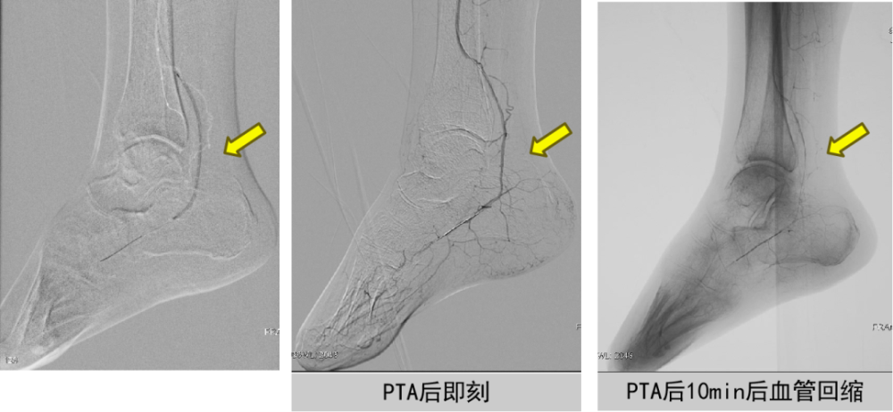 【问术ask】梁卫教授:踝下动脉双导丝球囊应用
