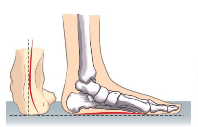 成语平足什么_平足是什么样子图片