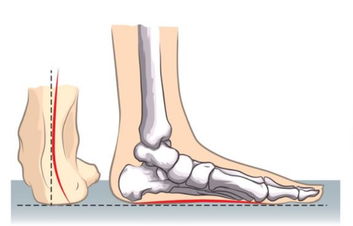 为什么有扁平足的人更容易引发大脚骨