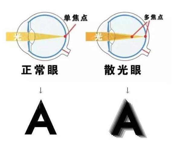 散光|验光|近视|亚蝌