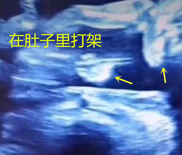 湖南一位双胞胎在肚里打架出生后浑身淤青(图)