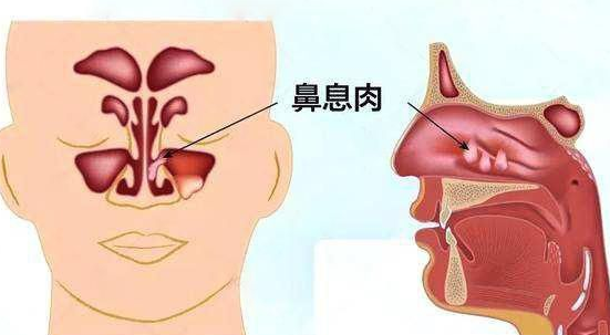 慢性鼻窦炎的鼻塞——鼻塞的症状轻重不等,多因鼻黏膜充血肿胀和分泌