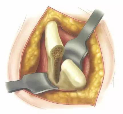 【骨科小技巧】髂骨取骨之切口的操作技巧!