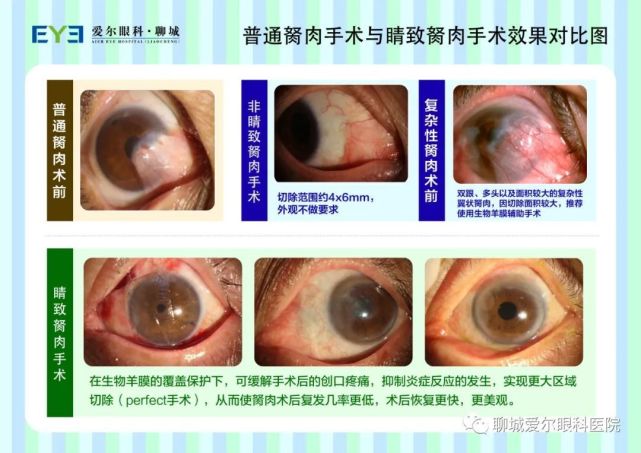 聊城爱尔眼科医院首例"睛致"翼状胬肉手术顺利完成