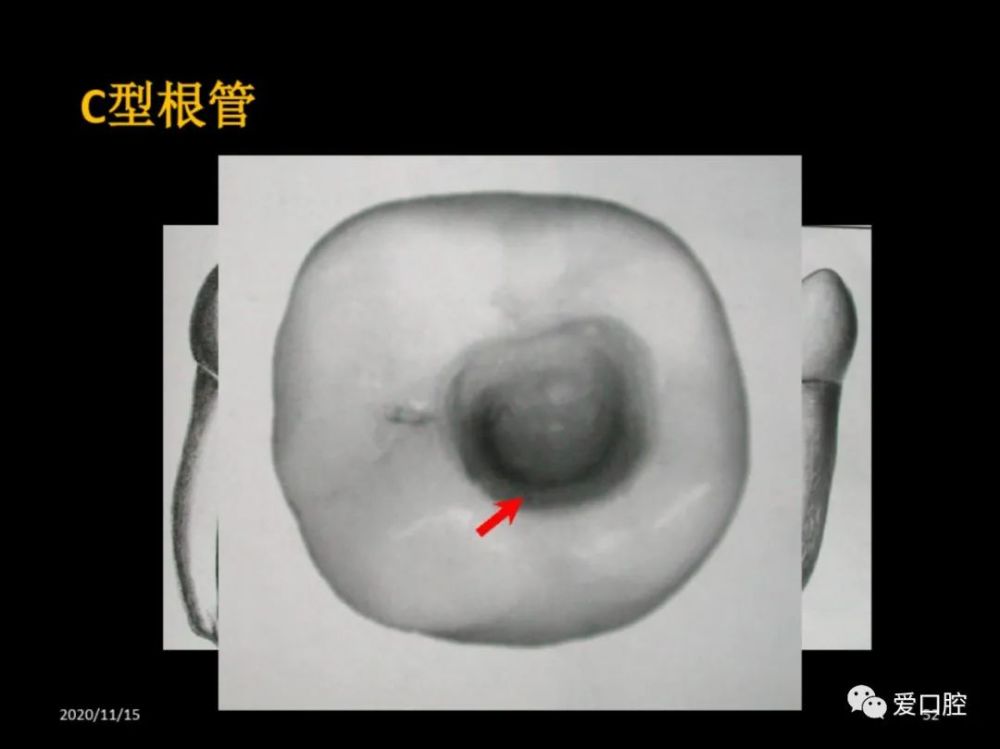 恒牙髓腔形态解剖特点