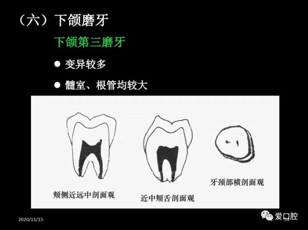 恒牙髓腔形态解剖特点