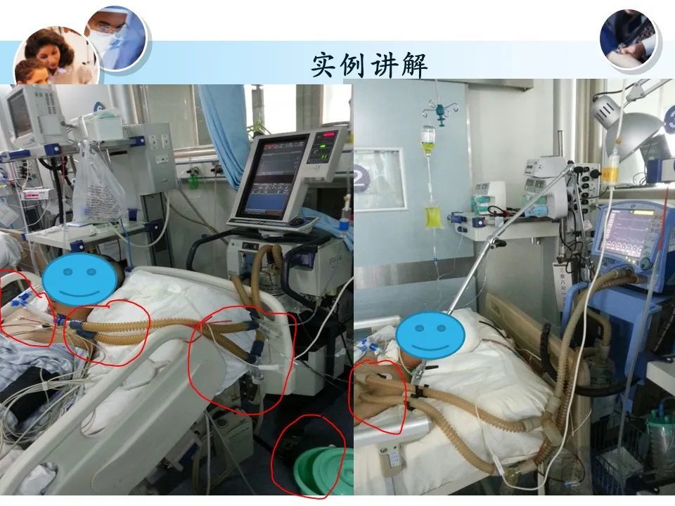 ppt:呼吸机冷凝水的管理