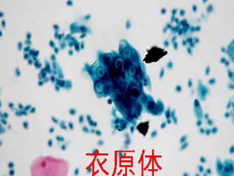 贝安健康衣原体感染有哪些治疗方案