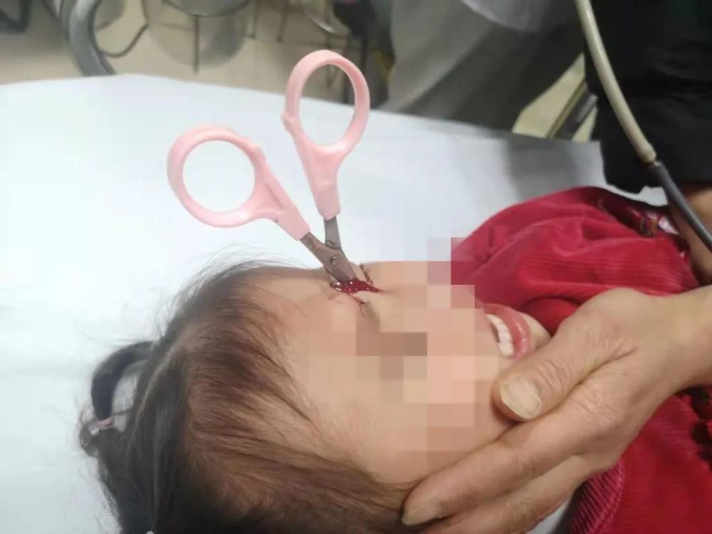 温州一小孩眼睛里竟插了把剪刀,太吓人了