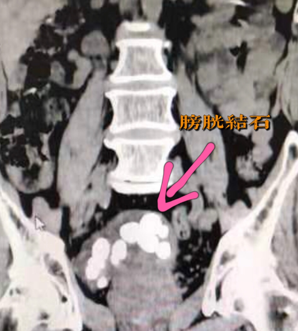 十年来排尿不畅,78岁爹爹膀胱内长了24颗石头