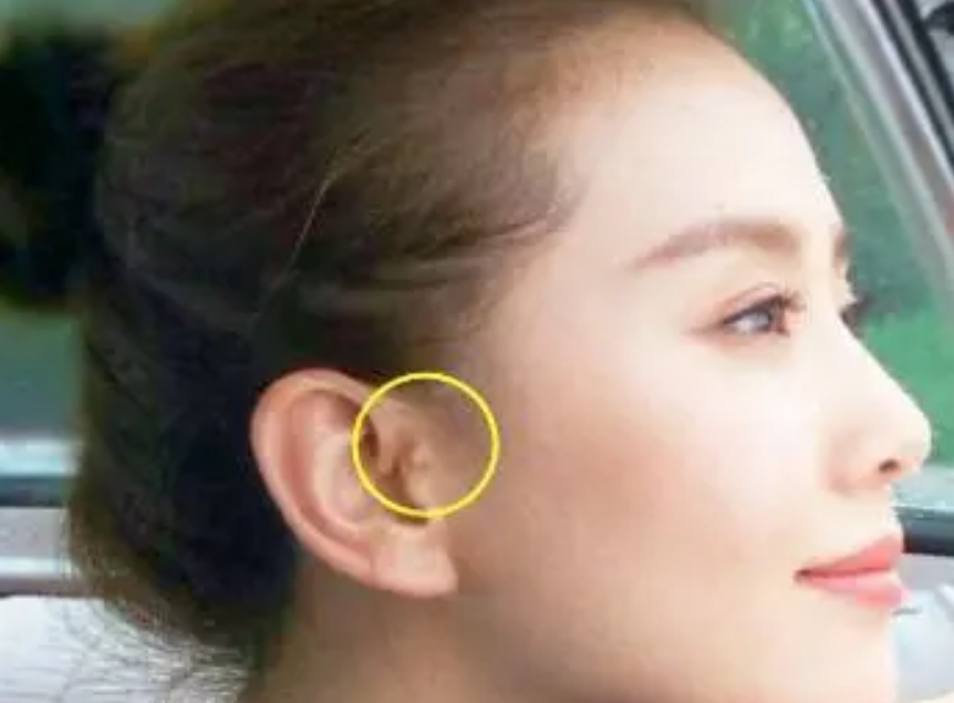 宝宝耳朵上有"拴马桩"代表有福气?别迷信,这肉球让很多娃自卑