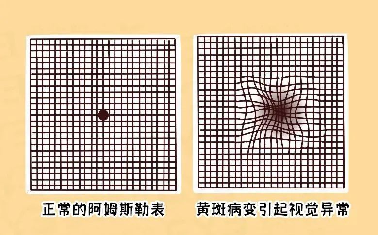 一图自测:你是否有这种致盲眼病