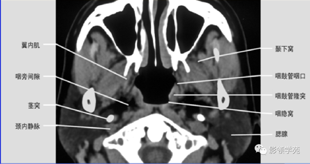 腮腺疾病的ct诊断与鉴别诊断